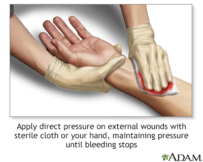 Stopping bleeding with direct pressure