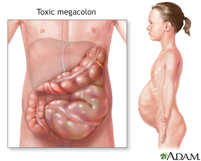 Toxic megacolon