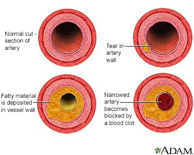 Developmental process of atherosclerosis