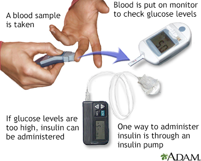 Glucose test