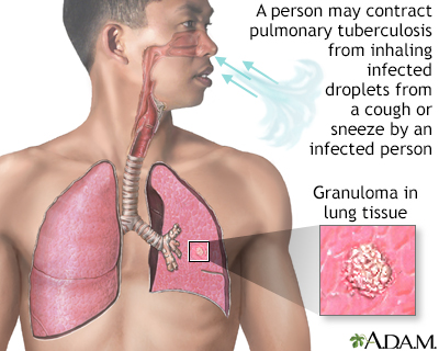 Tuberculosis of the lungs