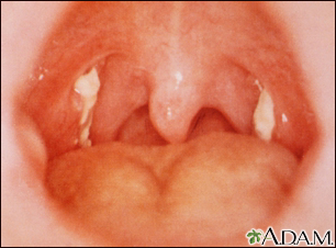Mononucleosis - view of the throat