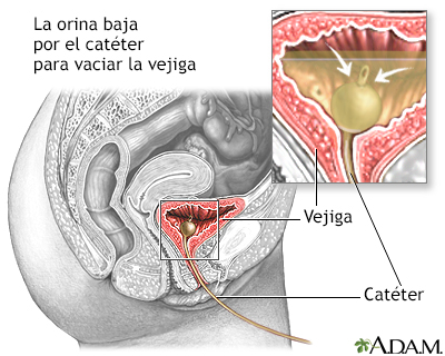 Cateterización de la vejiga en la mujer