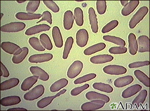 Glóbulos rojos - eliptocitosis