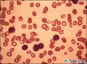 Chronic lymphocytic leukemia - microscopic view