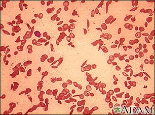 Glóbulos rojos - drepanocíticos