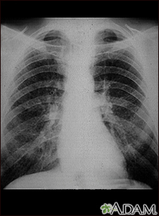 Pulmones de un trabajador del carbon -  radiografía de tórax