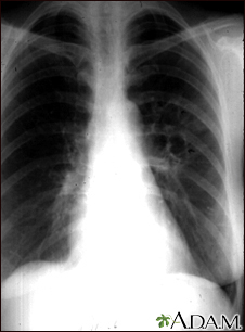 Coccidioidomicosis - radiografía de tórax