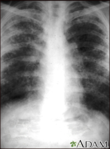 Sarcoidosis, estado II - radiografía de tórax