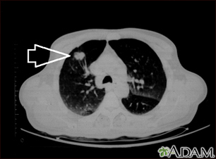 Masa pulmonar, lóbulo superior derecho - Tomografía computarizada