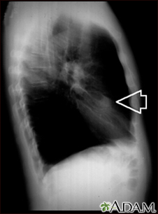 Nódulo pulmonar, lóbulo medio derecho - Radiografía de tórax