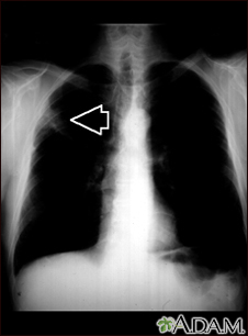 Masa pulmonar, pulmón superior derecho - Radiografía de tórax