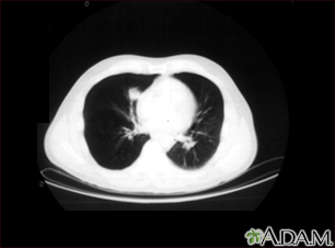 Nódulo pulmonar, pulmón inferior derecho - Tomografía computarizada