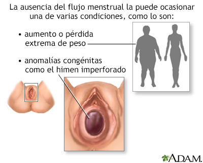 Ausencia de la menstruación (amenorrea)