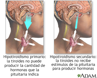 Hipotiroidismo primario y secundario