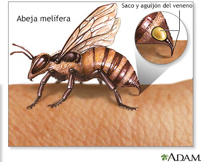 Picaduras de insectos y alergias