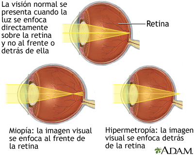Visión normal, miopía e hipermetropía