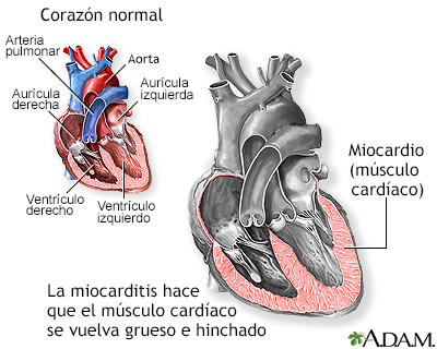 Miocarditis