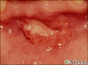 Úlcera de la boca (úlcera aftosa)