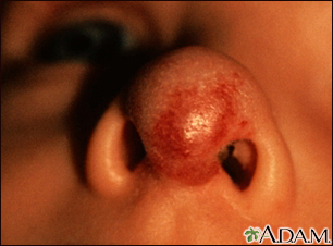 Hemangioma en la cara (nariz)