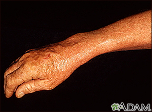 Léntigo - solar con eritema en el brazo