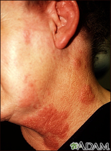 Herpes zoster (culebrilla) en cuello y mejilla