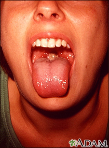 Mononucleosis - boca