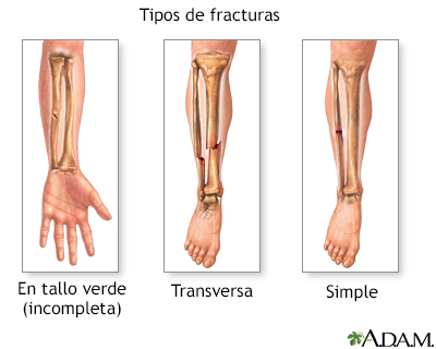 Tipos de fractura (2)