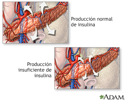 Producción de insulina y diabetes