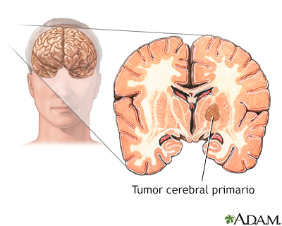 Tumor cerebral primario