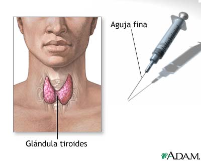 Biopsia de la glándula tiroides
