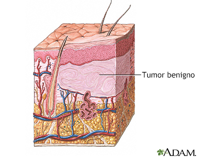 Tumor benigno de la piel