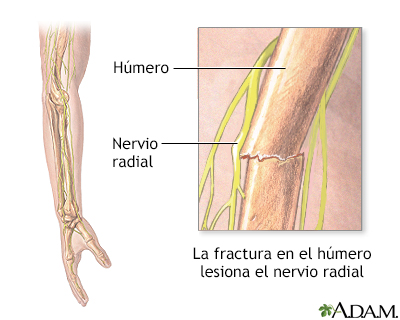 Disfunción del nervio radial
