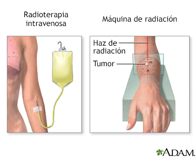 Terapia de radiación