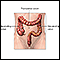 Large bowel resection - Series