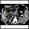 Hepatocellular cancer - CT scan