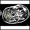 IRM del melanoma del hígado