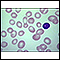 Megaloblastic anemia - view of red blood cells