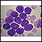 Microfotografía de leucemia linfocítica aguda