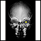 Neurofibromatosis I, agrandamiento de la abertura óptica