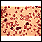 Leucemia linfocítica crónica - vista microscópica