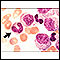 Vista microscópica - leucemia mielocítica crónica