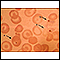 Malaria, fotomicrografía de parásitos celulares