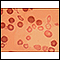 Thalassemia major