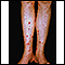 Púrpura de Henoch-Schonlein en la parte inferior de la piernas