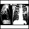 Tuberculosis, avanzada - radiografía de tórax