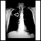 Masa pulmonar, pulmón superior derecho - Radiografía de tórax