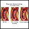 Acumulación progresiva de placa en arteria coronaria