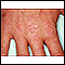 Dermatomiositis - pápulas de Gottron en las manos