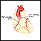 Angioplastia coronaria con balón - Serie